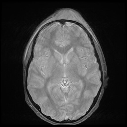 Pott Puffy Tumor Image Radiopaedia Org