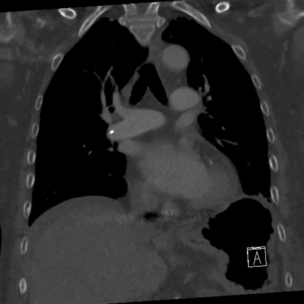 Incidental Finding Of Pulmonary Cement Embolism After Vertebroplasty