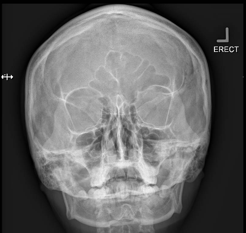 Normal Paranasal Sinuses X Ray Series Image Radiopaedia Org