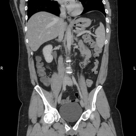 Lesser Omental Infarction Image Radiopaedia Org