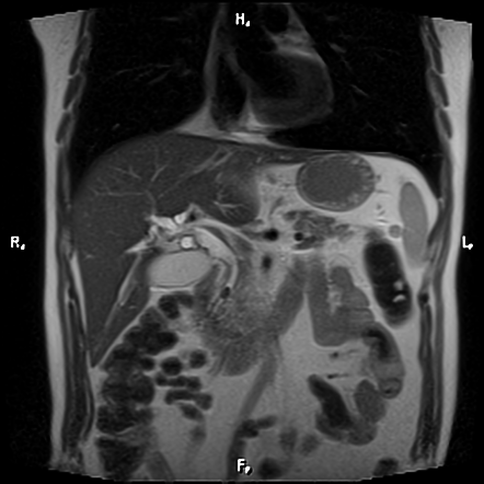 Choledocholithiasis Image Radiopaedia Org