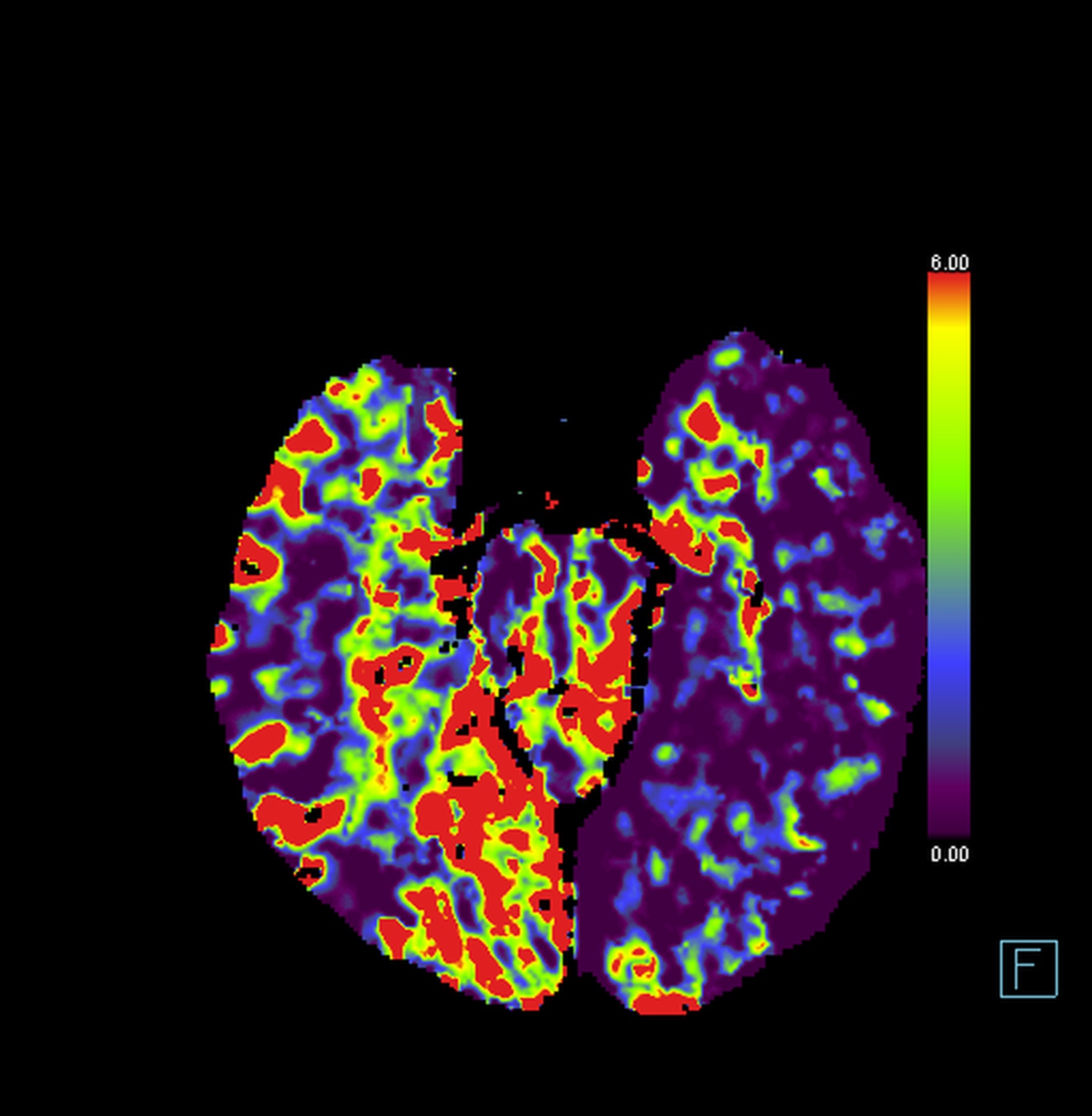 Cerebral Infarct Left Mca M Fetal Pca P Occlusion Image