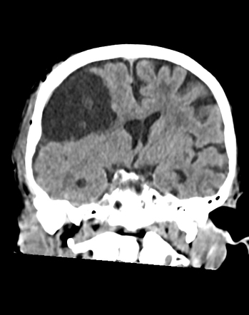 Traumatic Intracystic Hemorrhage Of Arachnoid Cyst Image