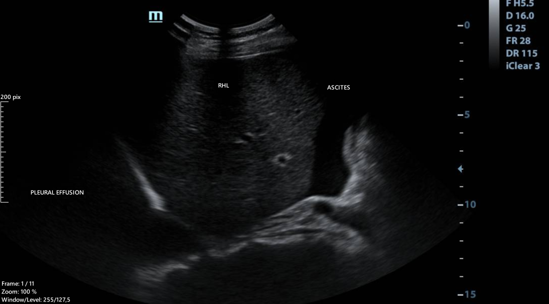 Meigs Syndrome Image Radiopaedia Org