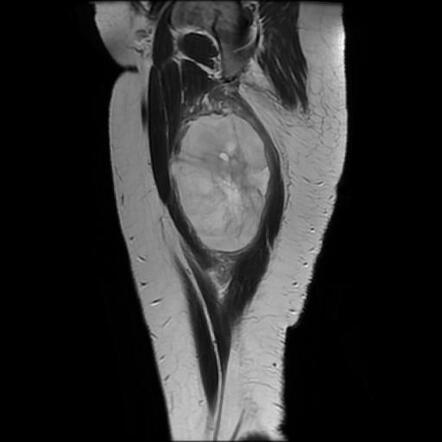 Myxoid Liposarcoma Radiology Case Radiopaedia Org