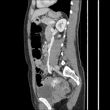 Pelvic Congestion Syndrome Radiology Reference Article Radiopaedia Org