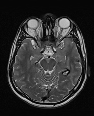 Cavernoma Radiology Case Radiopaedia Org