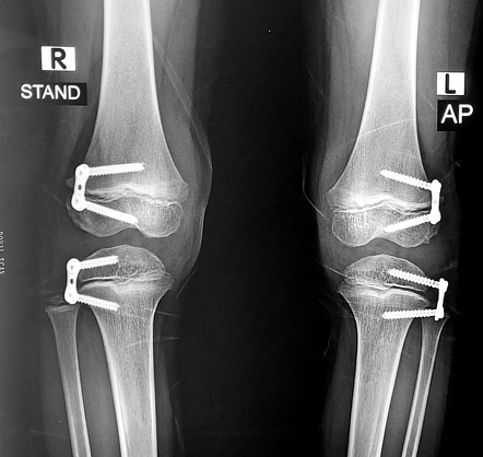 Temporary Hemiepiphysiodesis Knee Radiology Case Radiopaedia Org