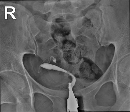 Unicornuate Uterus Radiology Case Radiopaedia Org