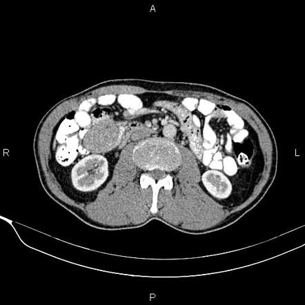 Gastrointestinal Stromal Tumor Radiology Case Radiopaedia Org