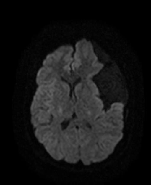 Arachnoid Cyst Middle Cranial Fossa Image Radiopaedia Org