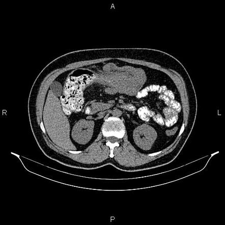 Colocolic Intussusception Due To The Tumoral Infiltration Image