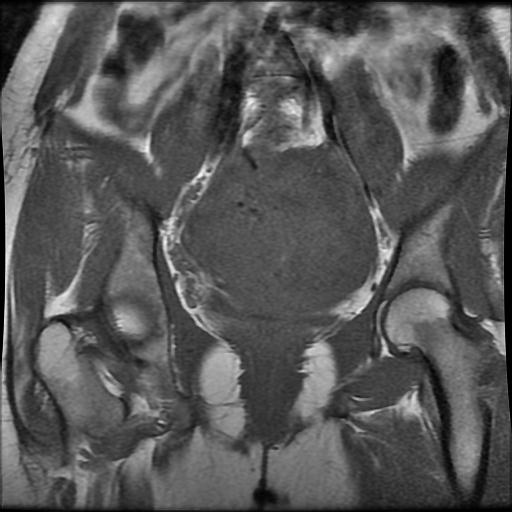 Pedunculated Subserous Uterine Leiomyoma Image Radiopaedia Org