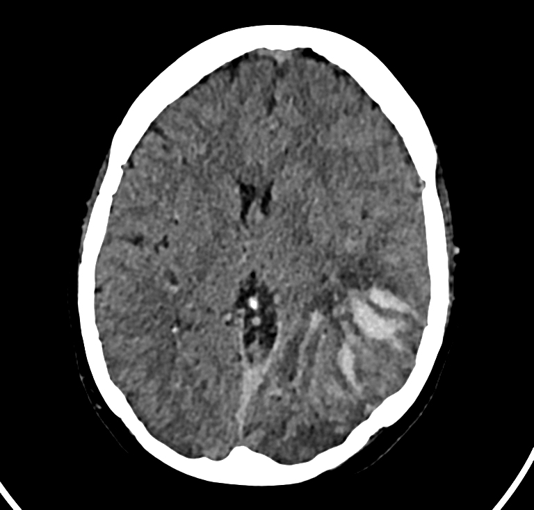 Cerebral Venous Hemorrhagic Infarction Image Radiopaedia Org