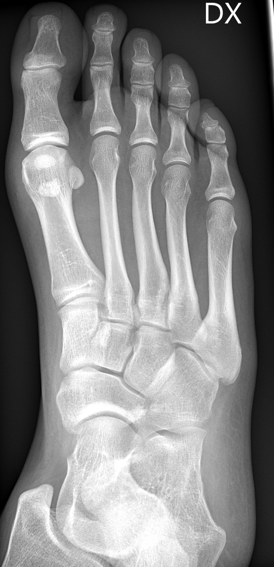 Medial Hallux Sesamoid Fracture Image Radiopaedia Org