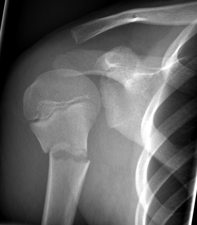 Shoulder Series Pediatric Radiology Reference Article Radiopaedia Org