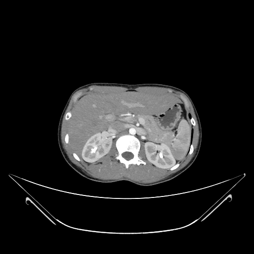 Bilateral Iatrogenic Pneumothoraces Image Radiopaedia Org