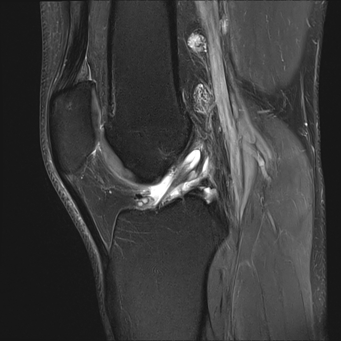 Anterior Cruciate Ligament Ganglion Cyst Image Radiopaedia Org