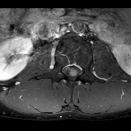 Cauda Equina Neuroendocrine Tumor Image Radiopaedia Org