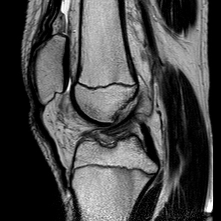 Anterior Cruciate Ligament Avulsion Fracture Image Radiopaedia Org