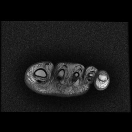 Epithelioid Sarcoma Forefoot Image Radiopaedia Org