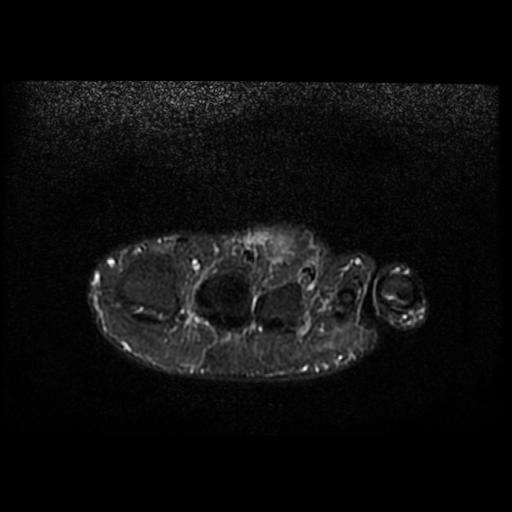 Epithelioid Sarcoma Forefoot Image Radiopaedia Org