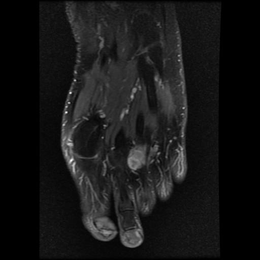 Epithelioid Sarcoma Forefoot Image Radiopaedia Org