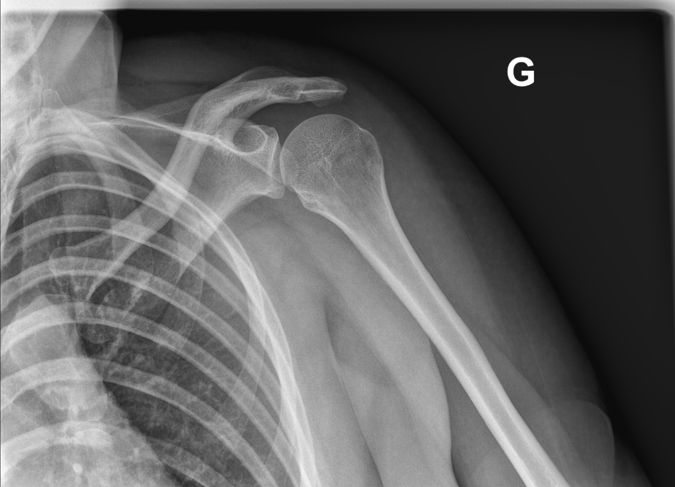 Greater Tuberosity Fracture Image Radiopaedia Org