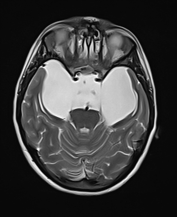 Large Arachnoid Cyst Suprasellar Radiology Case Radiopaedia Org