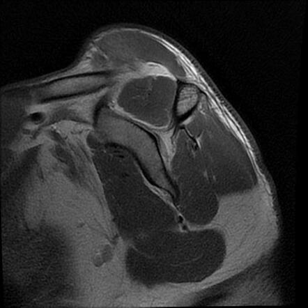 Distal Clavicular Fracture MRI Image Radiopaedia Org