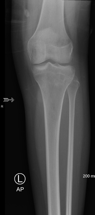 Osteosarcoma Radiology Case Radiopaedia Org