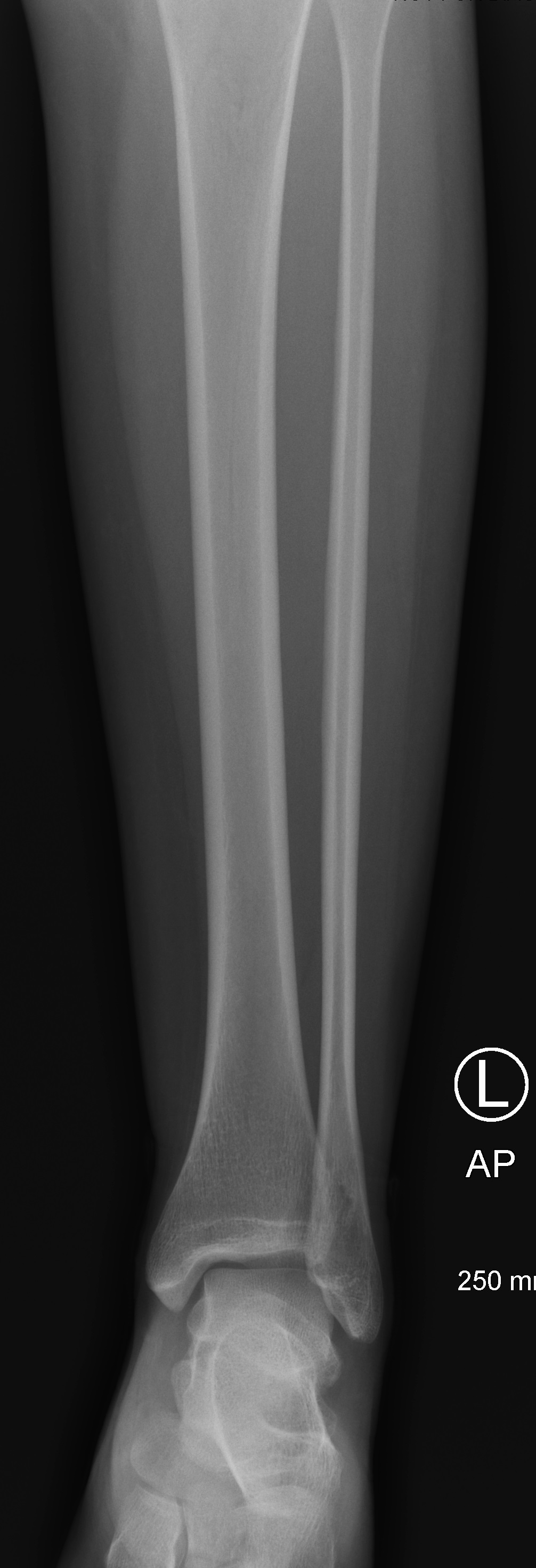 Osteosarcoma Image Radiopaedia Org