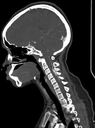 Cervical Dural Arteriovenous Fistula Radiology Case Radiopaedia Org