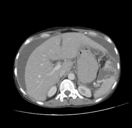 Peritoneal Tuberculosis TB Radiology Case Radiopaedia Org