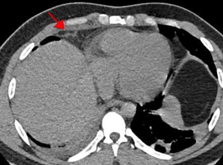 Epipericardial Fat Necrosis Radiology Case Radiopaedia Org