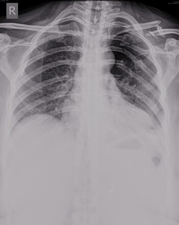 Flail Chest Image Radiopaedia Org