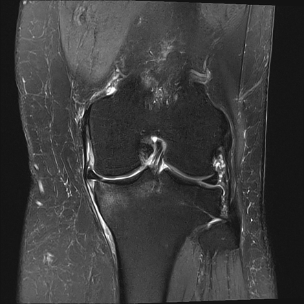 Meniscal Root Tear Radiology Reference Article Radiopaedia Org