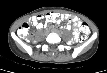 Jejunoileal Diverticulitis Radiology Reference Article Radiopaedia Org