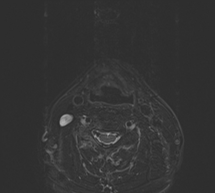 Spinal Schwannoma Radiology Reference Article Radiopaedia Org