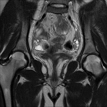 Mayer Rokitansky Küster Hauser syndrome MRKH with rudimentary uterine