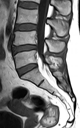 Epidural Lipomatosis Image Radiopaedia Org