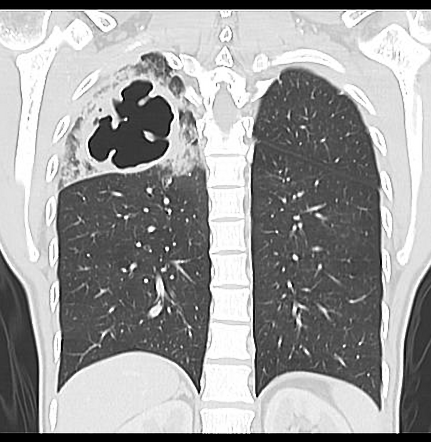 Pulmonary Tuberculosis Radiology Case Radiopaedia Org