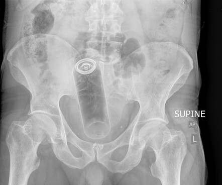 Foreign Body In Rectum Radiology Case Radiopaedia Org