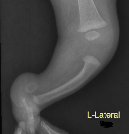 Fibular Hemimelia Radiology Case Radiopaedia Org