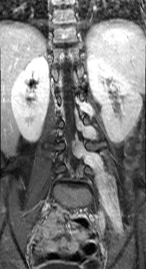 Plexiform Neurofibromas Image Radiopaedia Org