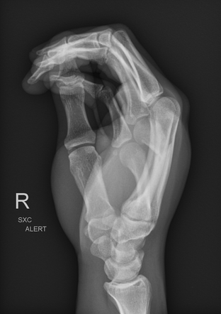 Fourth Metacarpal Neck And Fifth Metacarpal Base Fractures Image