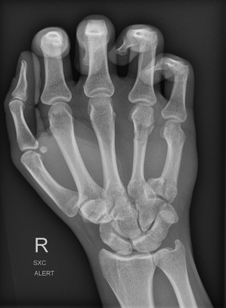 Fourth Metacarpal Neck And Fifth Metacarpal Base Fractures Radiology