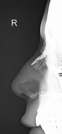 Nasal Bone Fracture Radiology Case Radiopaedia Org