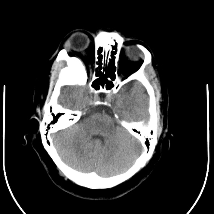 En Plaque Meningioma Radiology Case Radiopaedia Org