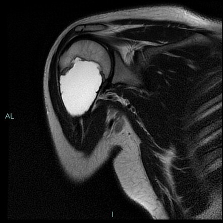 Unicameral Bone Cyst Of Humerus Radiology Case Radiopaedia Org